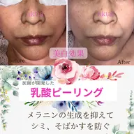 【ツヤ美肌ケア】乳酸ピーリングで美白、ツルモチ肌！！★小顔ハンドフェイシャル＆幹細胞パック！ミニモ限定