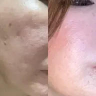 メンズOK!ニキビ、クレーター、毛穴にお悩みの方に効果絶対！ハーブピーリング（剥離あり）