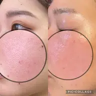 【最新肌管理🇰🇷🌿】ダクトピール✨ニキビ・肌荒れ・黒ずみ・くすみ