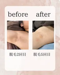 最新【スピード美肌脱毛】両脇1回