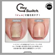 フット巻き爪・トラブル爪緩和