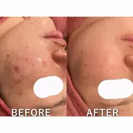 ハーブピーリング1部位