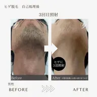 【メンズ脱毛40%off🔥】minimo特別価格🌿コラーゲン脱毛✳︎ヒゲ脱毛💎全当て、デザイン可◎　#本八幡 脱毛