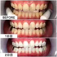 【満足度No.1 】プレミアムコース ​〜​短期間で集中的に。美しく上品な白さへ。​〜​2来店 計115分×9回照射
