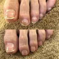 痛い巻き爪も解消！爪周りケア付きメンズ専門店