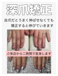 深爪矯正【長さ出し】◆カラーあり◆(オフ込)むしったり 割れたり 噛んで小さくなってしまった爪も美しく綺麗な状態に✧︎