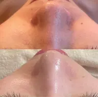 人気No.1【毛穴・くすみ】炭酸ツヤ肌フェイシャル✨1回でツヤ肌へ