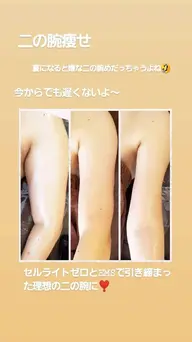 【1ヶ所体験】セルZERO(二の腕　お腹　背中ets)《キャビ＋ラジオ波＋サイクロン》