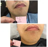 新規メンズひげ脱毛