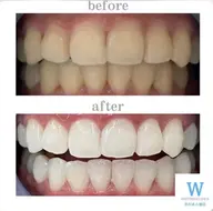 【お試し３回来店コース】ホワイトニング40分×3来店¥23,000→¥16,200