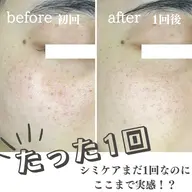 シミケア20ショット＋超音波毛穴洗浄コース
