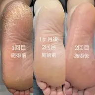 常識をくつがえす新しい角質ケア！！『エンザイム角質ビットケア®︎』