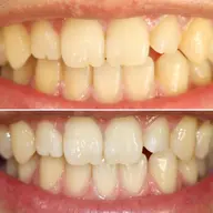 セルフホワイトニング15分×3回