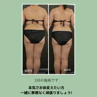 筋膜リリース(90分)