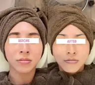 【✨1日1名様限定✨】エラ張りが気になる方へエラ改善コース