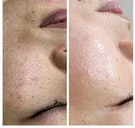 土日限定✨肌診断付💓【韓国で大人気水光肌✨️】大人気水光ピール✨毛穴レス、繰り返すニキビなど、憧れのツヤ感水光肌へ💕