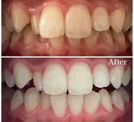 🦷歯のセルフホワイトニング🦷　14分× 3回