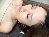 【すっきり小顔】電気を流す美容鍼灸🕊カッサヘッドマッサージ付