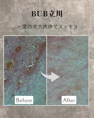 【メンズ毛穴汚れを根こそぎ】ハイドラ毛穴洗浄No.1人気｜黒ずみ・角栓・皮脂を一気にオフ🥇