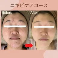 【大人ニキビケアコース】毛穴洗浄・パック・マッサージ（ニキビ・皮脂過剰分泌😷マスクニキビにもおすすめ😷）