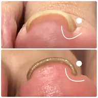 巻き爪ケアネイル