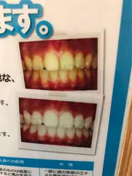 セルフホワトニング