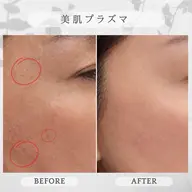 💎美肌プラズマ💎《シミ・黒ずみが気になる方》
