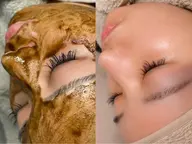 ハーブピーリング🫧ハイドラ毛穴洗浄付き！