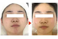 ❤️✨ニキビ対策緊急対策❤️ダブルパックで徹底保湿&顔ダニ除去でニキビ対策60分コース‼️デコルテ、顔リンパマッサージ有