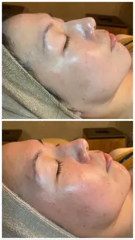 REVI陶肌トリートメント［ハーブピーリング］