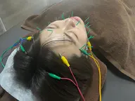 《美容鍼》電気パルス・首調整・ヘッドマッサージ付き