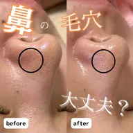 黒ずみ毛穴/ポツポツ毛穴/鼻の黒ずみ👃フェイシャル&デコルテ背中マッサージ込み🤍【角栓毛穴洗浄フェイシャル】