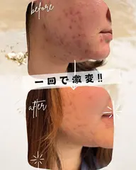 鎮静クレイマスクで気になるニキビケア‼︎