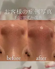 【毛穴黒ずみオフ】大人の毛穴悩みに!皮脂詰まり黒ずみ撃退🔥