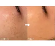 シミケア　取り放題　(20分)