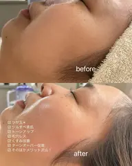 フェイスワックス！鎮静クリームパック付き✨フェイスワックスでしか手に入らないツルツル素肌を体感してくださいませ🤭