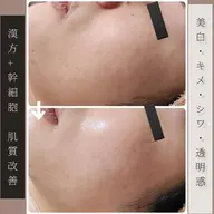 【憧れのツルツル陶器肌】剥離なし肌質改善ハーブピーリング