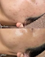 《韓国女優肌管理》LHALALAララピール×ララ専用女優マスク