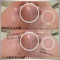 【人気No. 1】集中毛穴ケア 陶器肌・ノーファンデフェイシャル90分¥16500→7500(4/15​〜​価格改定予定)