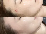 【新規】最先端美肌施術プラズマシャワー照射+美容液導入【ニキビ/肌荒れ/角質ケア】