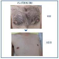 平日限定！定価7500円のところmen'sヒゲ脱毛3パーツ1900円