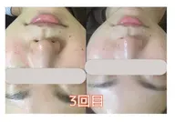 【海外セレブで人気爆発❤️】透明感ある毛穴レス卵肌に♪ハイドラフェイシャル✨