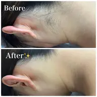 🎈うなじ＋背中＋顔脱毛🎈