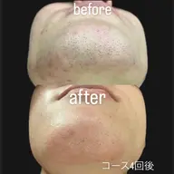 メンズ🩵【ヒゲ脱毛】痛み最小限✨