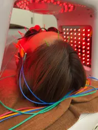 プレミアム美容鍼