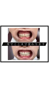 【ホワイトニング】8分1セット🦷✨