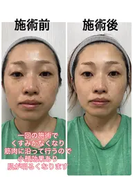 老化角質除去！古い角質よ！さようなら！フェイシャル体験2,980円