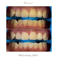 【ホワイトニング初めての方へ】ライトコース 1回/4回照射