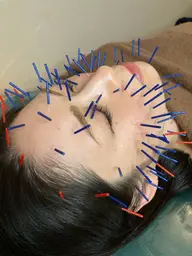 【ミニモ限定割】整形級!100本美容鍼|本格派・肌再生・小顔・リフトアップ☆初回限定