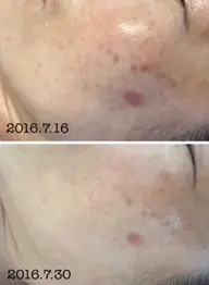 持続力No.1❗️❗️大人気✨小鼻、アゴザラザラとシミさよなら4回コース